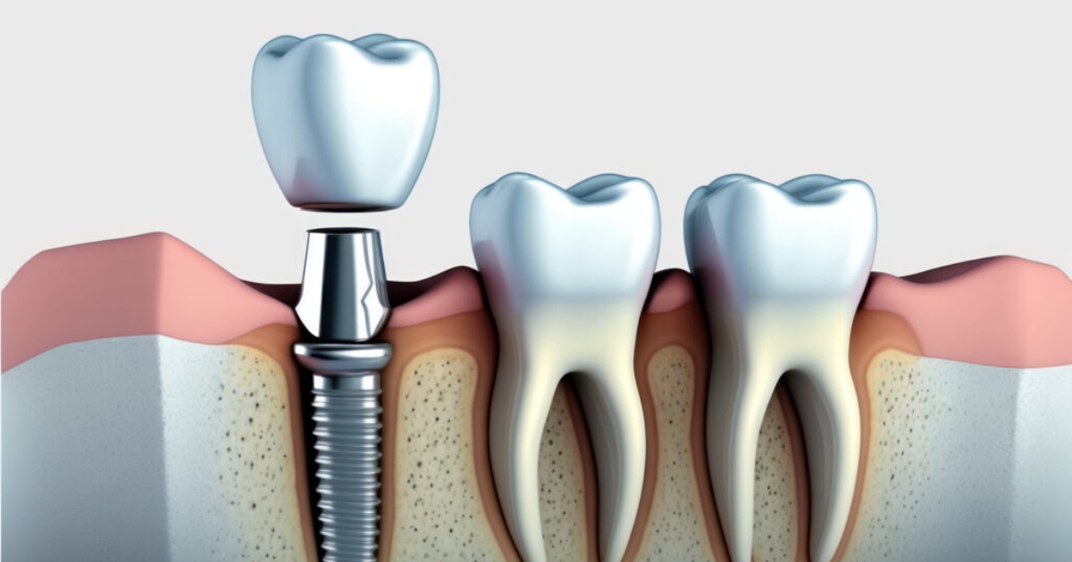 How To Prepare For A Dental Implant Restoration