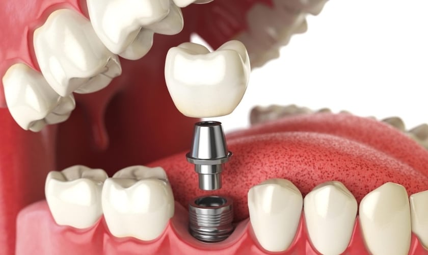 Caring for Your Dental Implants: Tips for Long-Lasting Results