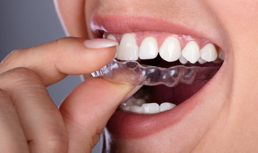 Invisible Braces for a Discreet Smile