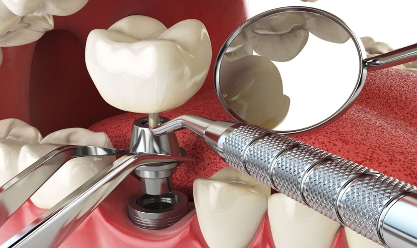 Missing Teeth No More!