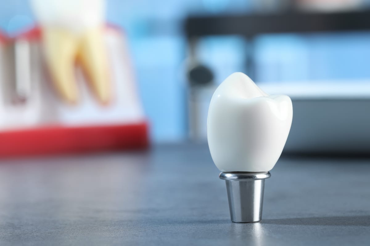 Dental Bridges in Westland