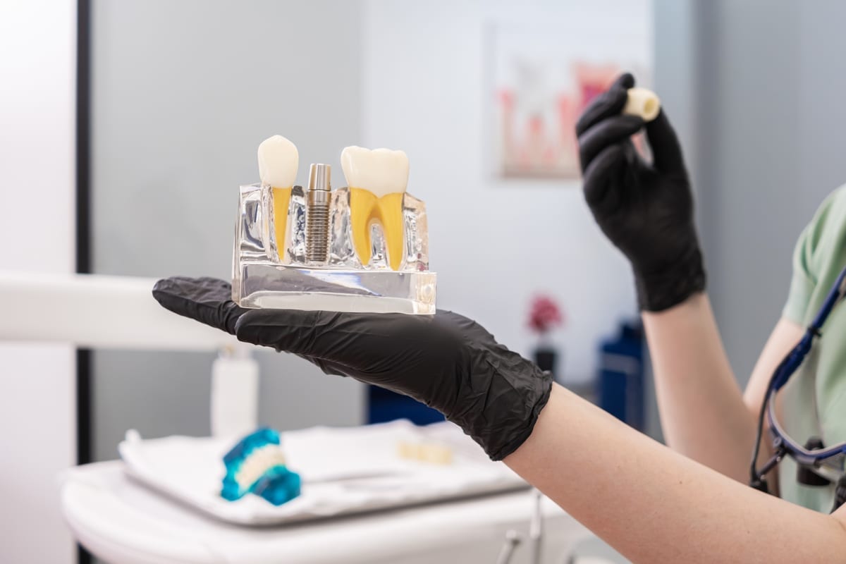 Dental Crowns in Canton Township