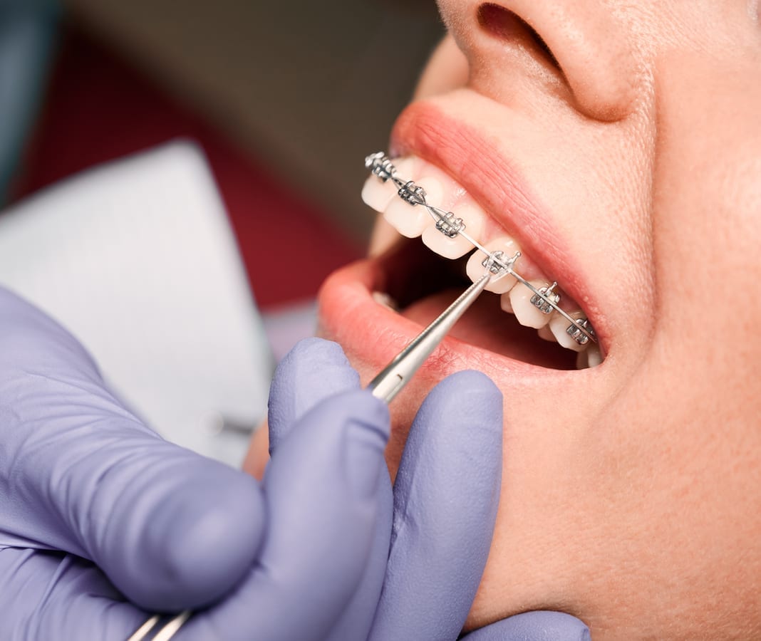 Full-Mouth Restoration in Canton Township