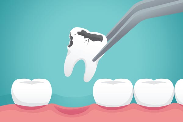 Ask a General Dentist: What Happens to Your Tooth After Extraction from Canton-Plymouth Family Dentistry in Canton, MI