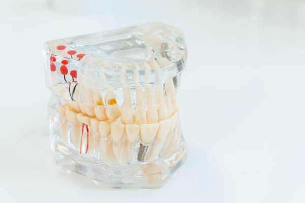 Dental Implants Canton, MI