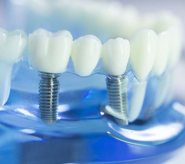 Canton Dental Implants